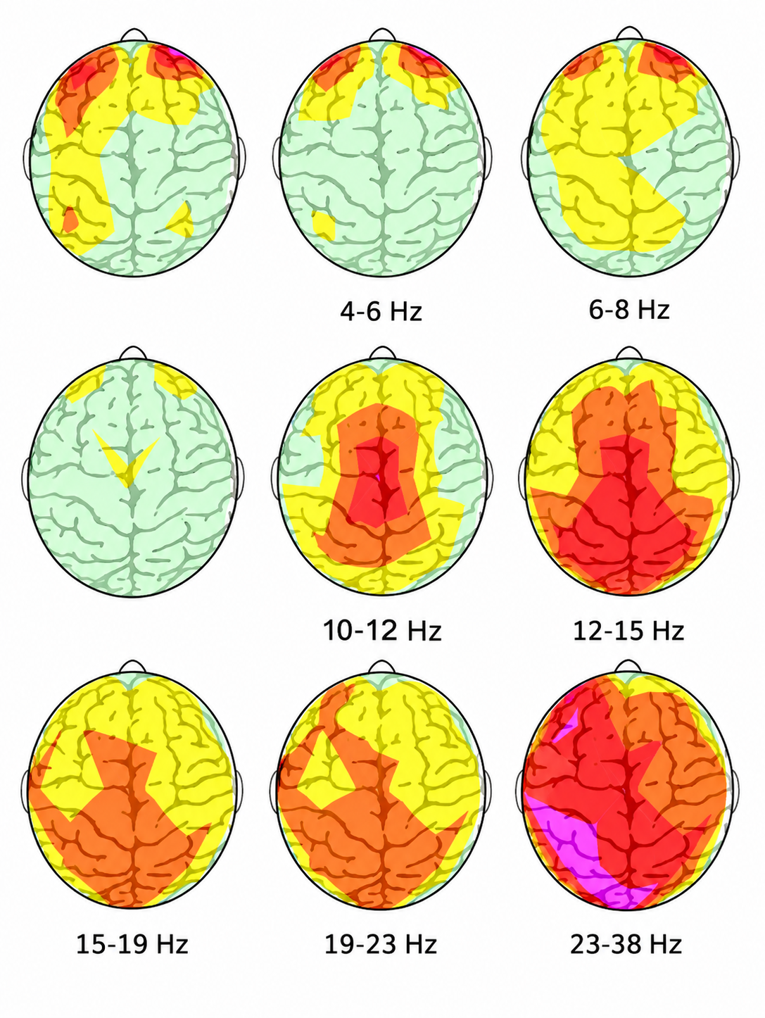 Mapas de análisis QEEG