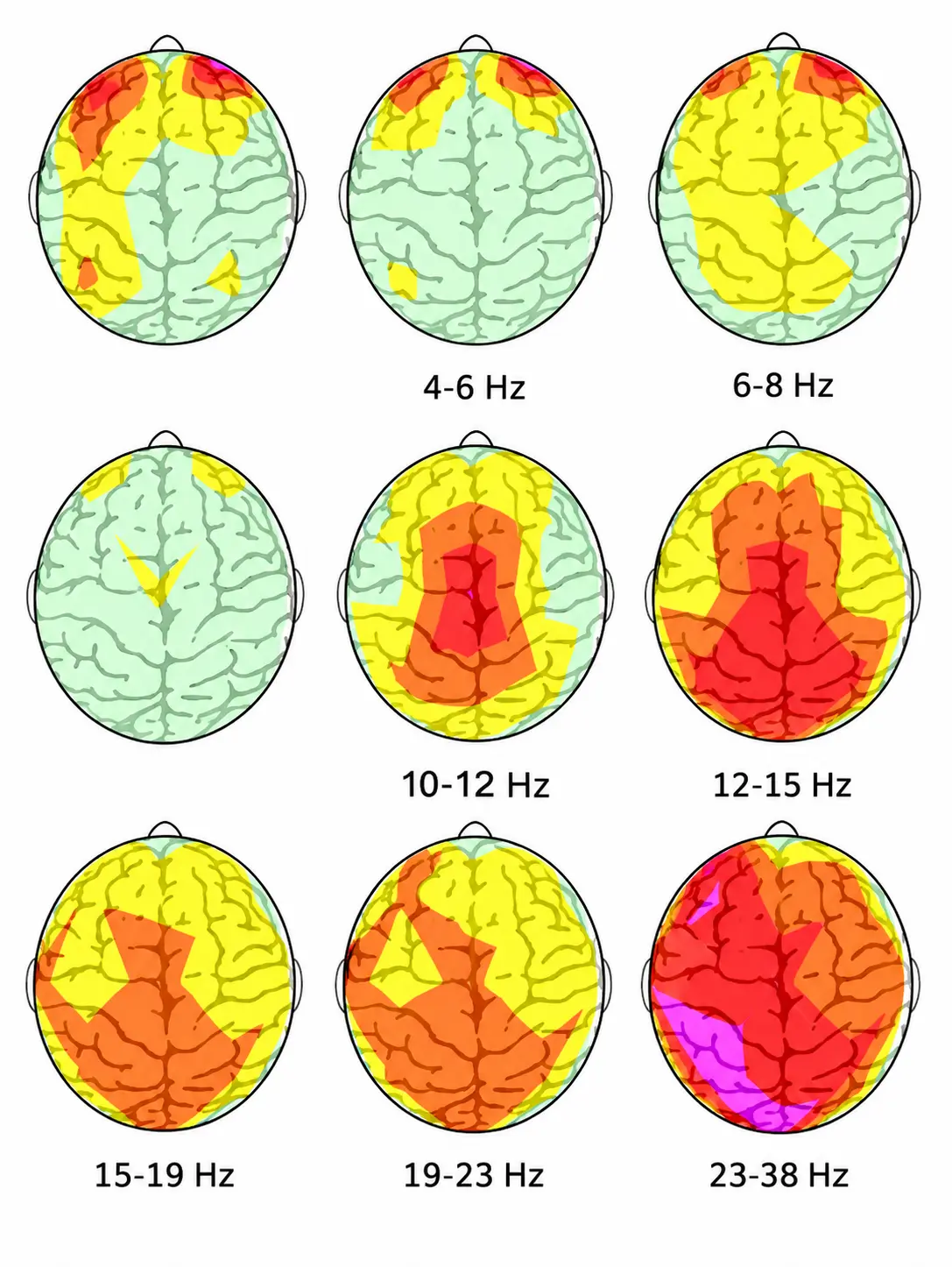Mapas de análisis QEEG